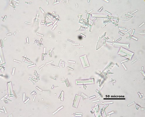 1024px-Struvite_crystals_dog_with_scale_1-495x400